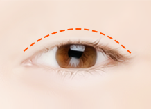 Steps for Non-incision Double Eyelid Surgery Method
