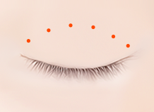 Steps for Non-Incision Ptosis Correction Surgery Method