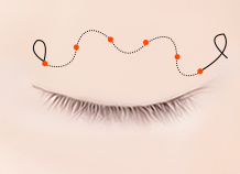 Steps for Non-Incision Ptosis Correction Surgery Method