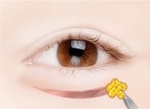 lower blepharoplasty surgery method