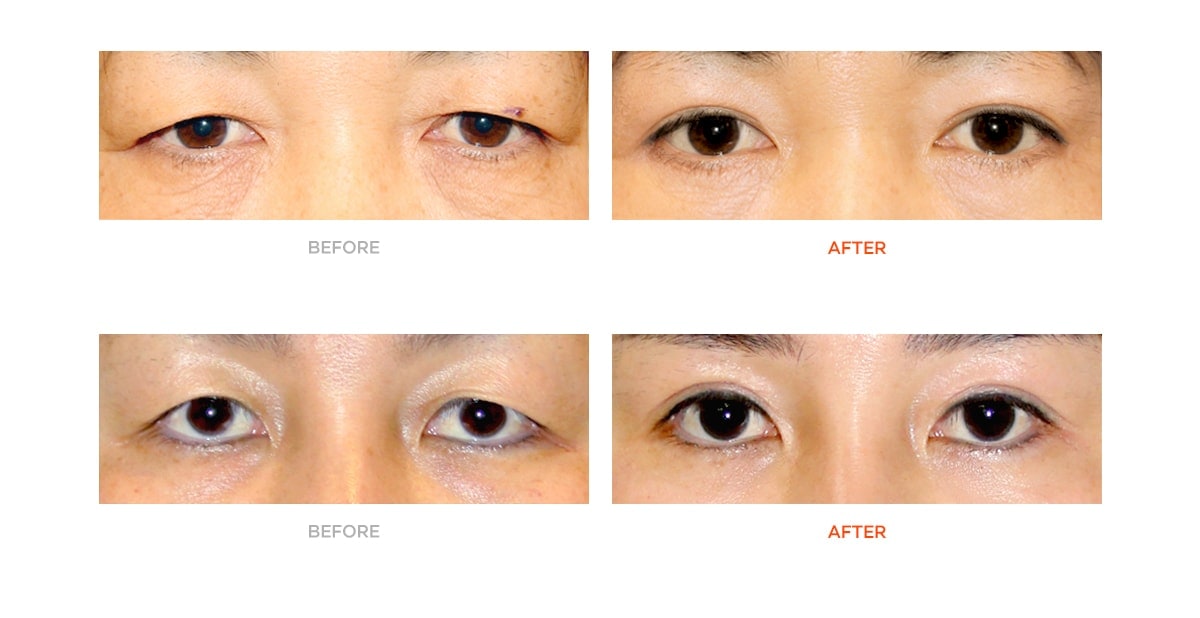 Upper eyelid surgery before and after