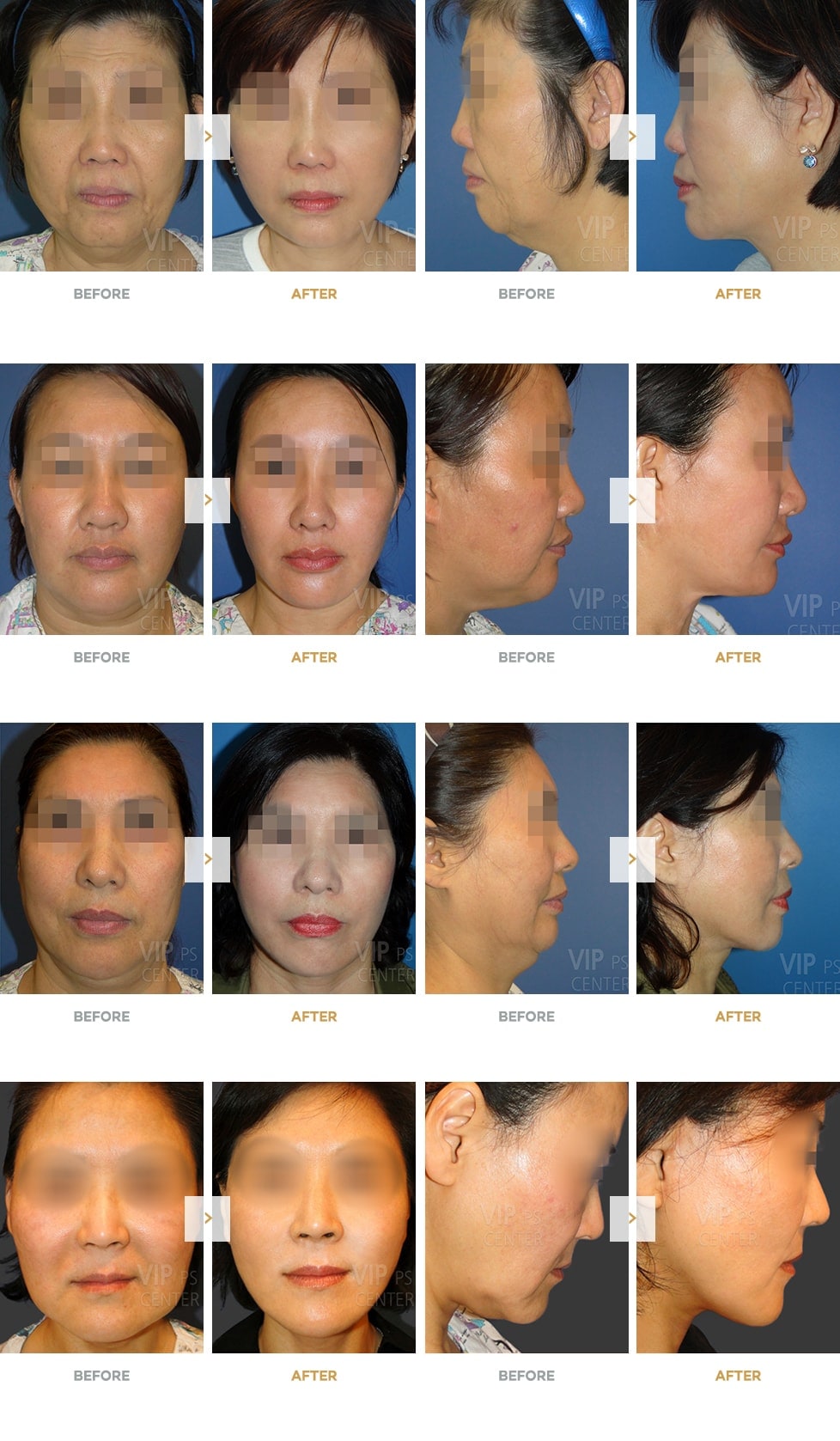 Smas facelift before and after