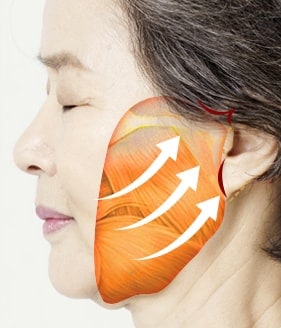 High smas facelift surgery method