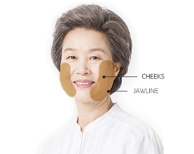 Minimum Incision Facelift surgery area