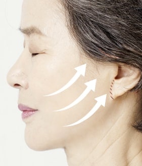 mini facelift surgery method