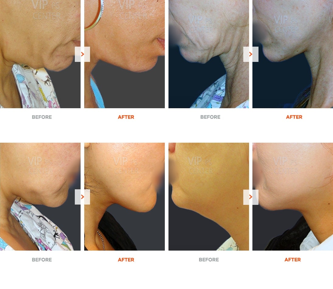 Necklift before and after