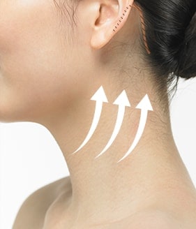 Necklift Surgery Method