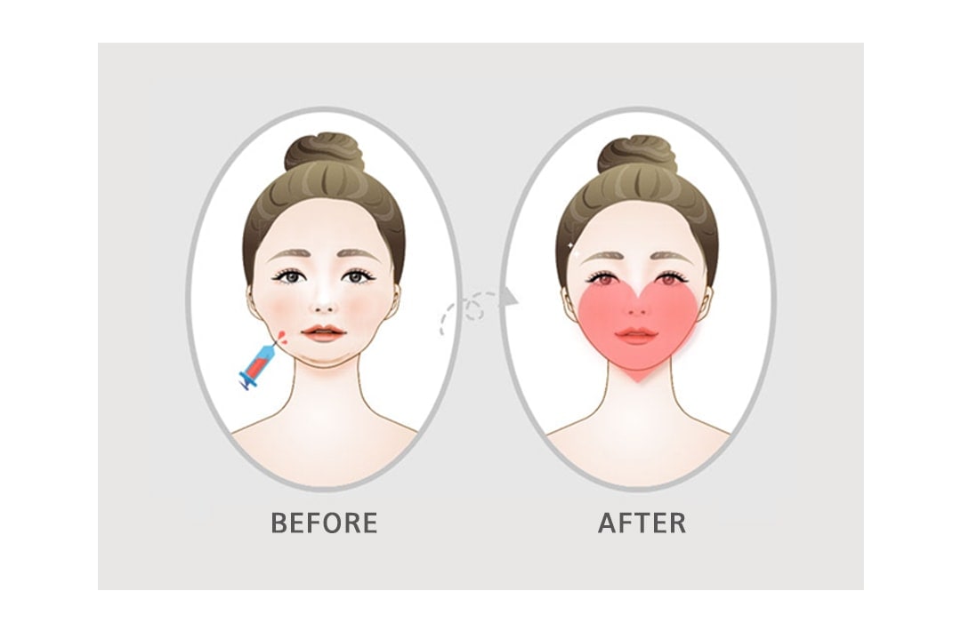 Non-surgical Heart Line Face Before and After