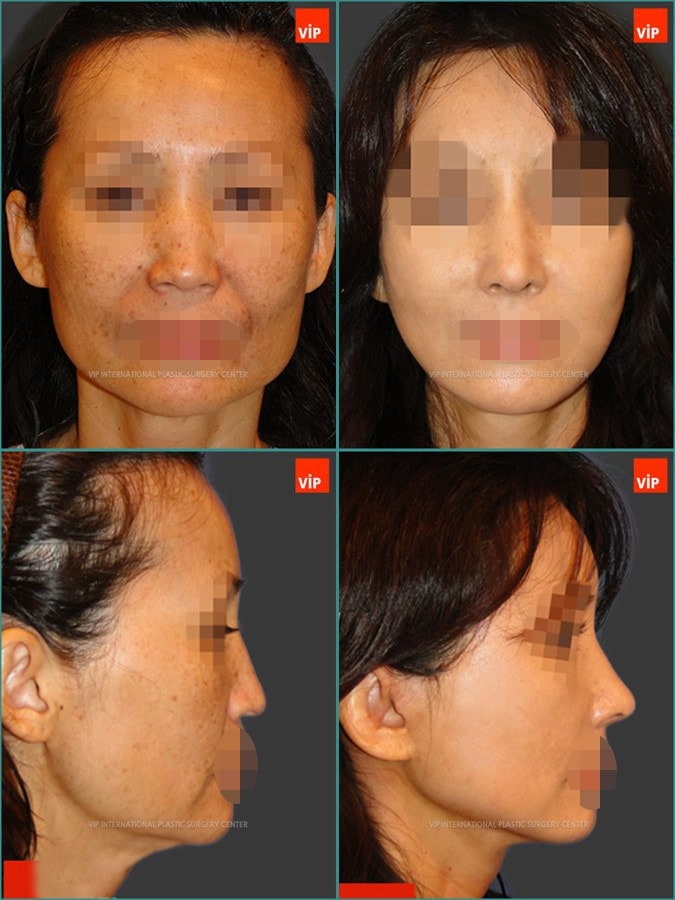 Anti aging surgeries -Case Study