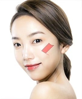 Cheekbone Reduction Surgery Method – Step 1