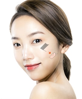 Cheekbone Reduction Surgery Method – Step 2