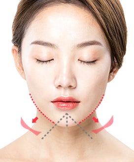 Chin Surgery Method - T-Cut Chin Surgery – Step 3