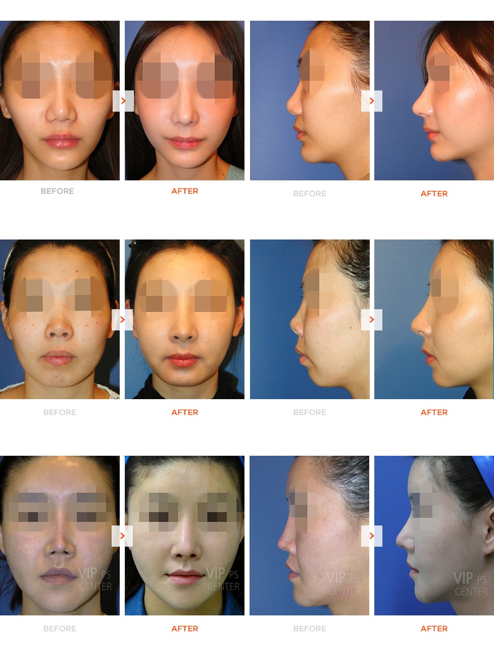 Stem cell fat grafting before and after