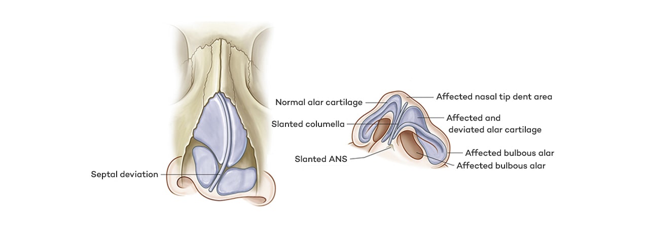 7 Main Symptoms of Cleft Lips