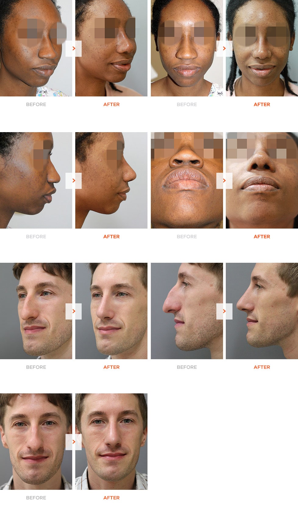 Ethnic Rhinoplasty Before and After