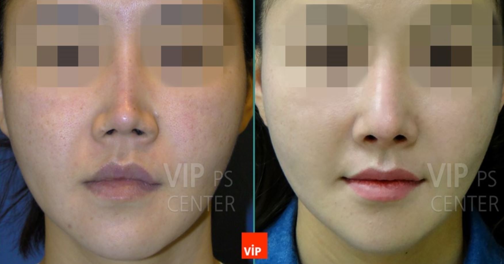 Revision Rhinoplasty Before and After(Deformity)