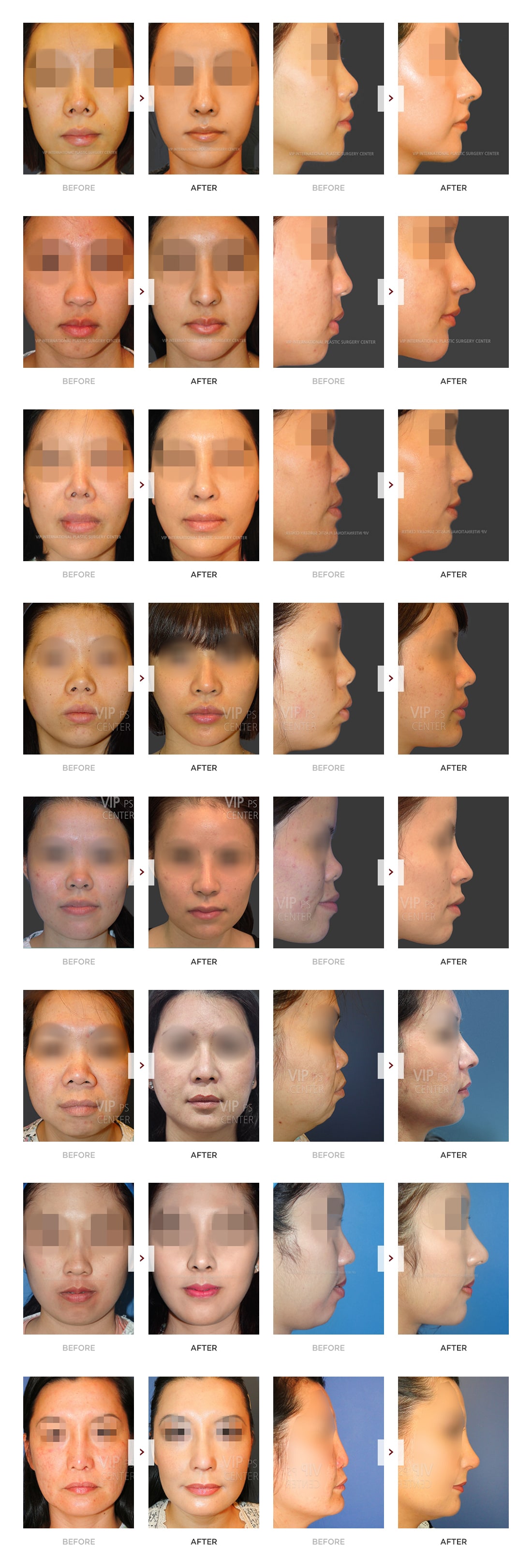 Rib Cartilage Rhinoplasty Before and After