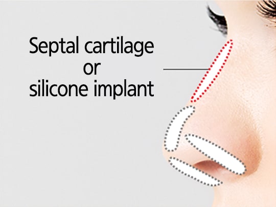 Simple Rhinoplasty Surgery Method (Septal Cartilage or Silicon Implant)
